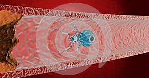 The nanorobot removed cholesterol plaques. Concept of the future. 3D render