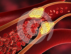 Narrowing of a blood vessel - 3d illustration