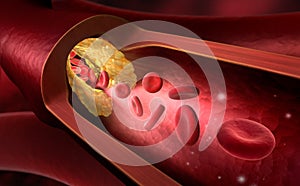 Narrowing of a blood vessel - 3d illustration