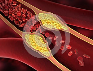 Narrowing of a blood vessel - 3d illustration photo