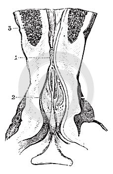 Narrowing of the membranous area of the urethra with dilatation