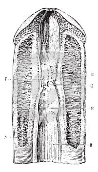 Narrowing of the urethra several consecutive blennorrhagias, vin