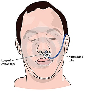 Nasal bridle