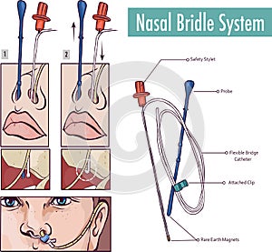 A nasal bridle attaching a nasogastric tube to the nasal septum to prevent accidental pullout