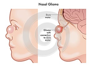 Nasal Glioma medical illustration photo