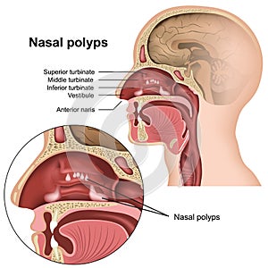 Nasal polyps medical  illustration on white background photo