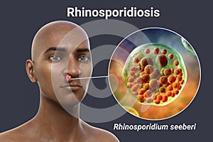 Nasal rhinosporidiosis in a patient, 3D illustration. A disease caused by Rhinosporidium seeberi parasite