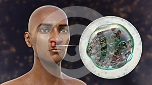 Nasal rhinosporidiosis in a patient, 3D illustration. A disease caused by Rhinosporidium seeberi parasite