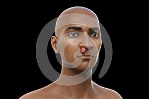 Nasal rhinosporidiosis in a patient, 3D illustration. A disease caused by Rhinosporidium seeberi parasite