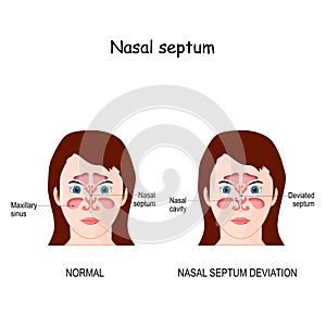 Nasal septum deviation photo