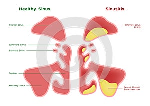 Nasal sinus. Healthy and inflammation sinus vector photo