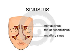 Nasal sinus. inflammation