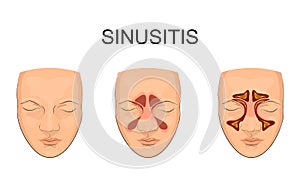 Nasal sinus. inflammation