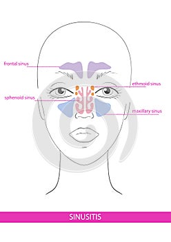 Nasal sinus. inflammation