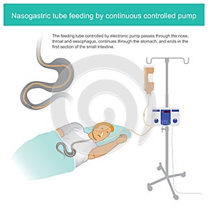 Nasogastric tube feeding by continuous controlled pump 25x25