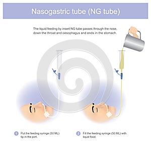 Nasogastric tube. The liquid feeding by insert NG tube passes th