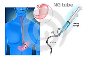 Nasogastric tube or NG tube