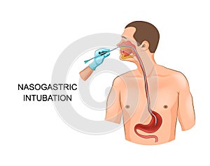 Nasogastric tube in the stomach photo