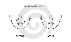 Nasolabial folds, laser cosmetology before procedure and after applying treatment line icon in vector. Illustration of a