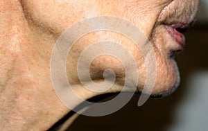 Nasolabial wrinkles. Wrinkles on the skin of the face of the neck. Flabby cheeks and neck photo
