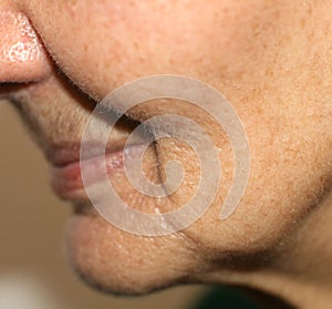 Nasolabial wrinkles. Wrinkles on the skin of the face of the neck. Flabby cheeks and neck