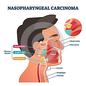 Nasopharyngeal carcinoma tumor, vector illustration photo