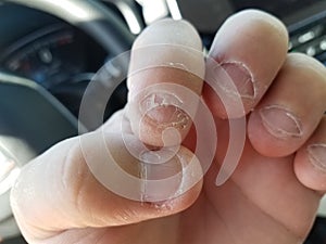 Nasty disgusting bitten and peeling fingernails in car