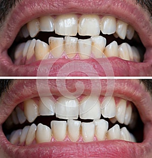 Natural Teeth Bleaching, Teeth Before And After Whitening, Dental Care and Treatment Process