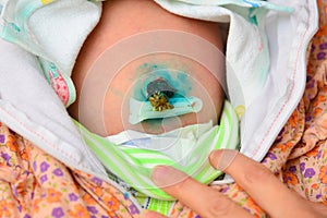 Navel of a newborn baby, umbilical cord treated with green paint