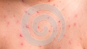 NChicken pox rash photo