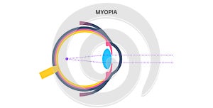 Nearsightedness eye disease