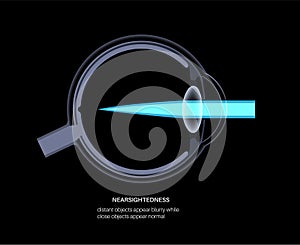 Nearsightedness eye disease