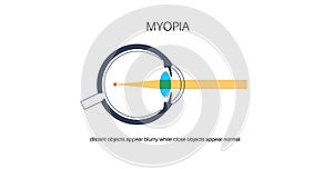 Nearsightedness eye disease