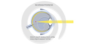 Nearsightedness eye disease photo