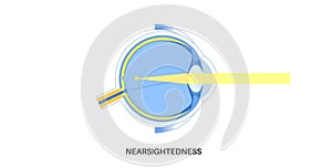 Nearsightedness eye disease