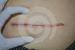 Neat, tidy and clean hypertrophic scar. Straight surgical incision