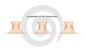Neck with enlarged thyroid gland photo