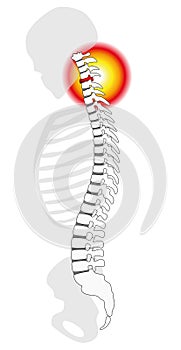 Neck Pain Cervical Vertebrae Spinal Disc Prolapse