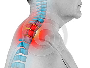 Neck pain, sciatica and scoliosis in the cervical spine isolated on white background, chiropractor treatment concept