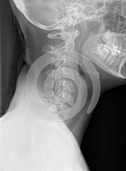 Neck X-Ray