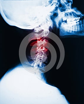 Neck x-ray and pain