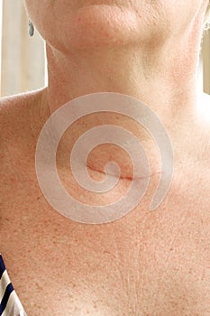 Neck scar after thyroidectomy.Closeup