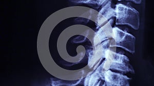 Neck spine MRI Scan or X-Ray video toned