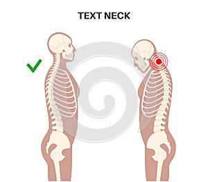 Neck vertebrae deformity