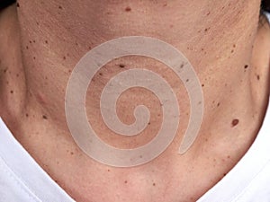 Neck of a woman with many small moles and warts