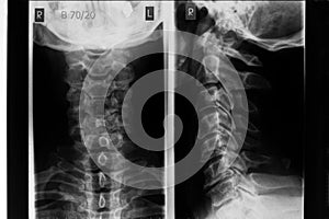 Neck xray