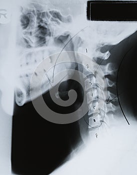 Neck Xray
