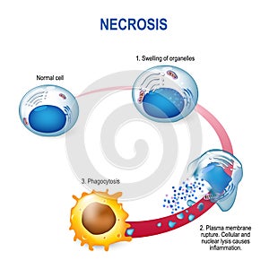 Necrosis