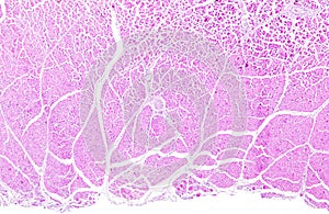 Necrosis of skeletal muscle of a human