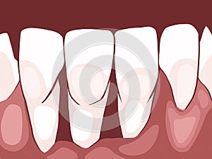 Necrotizing ulcerative gingivitis is a periodontal diseases